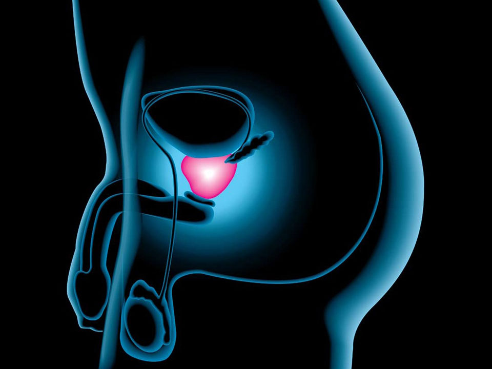cancer prostata benigno)