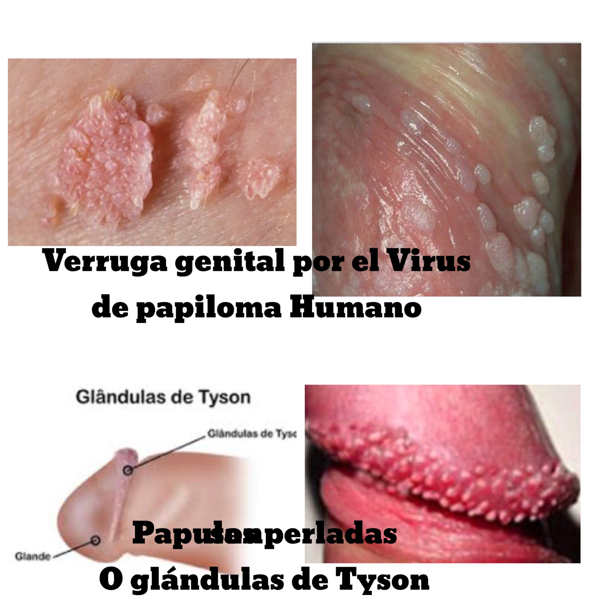 Virus papiloma glande. Infectia cu HPV din perspectiva dermatologului