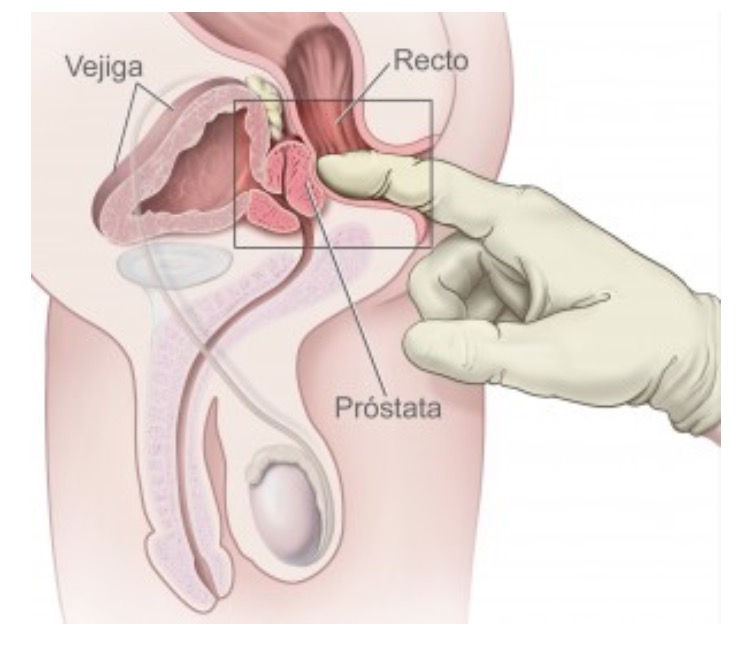 ¿Cómo Se Diagnóstica Un Cáncer De Próstata Y Cuál Es Su Tratamiento ?